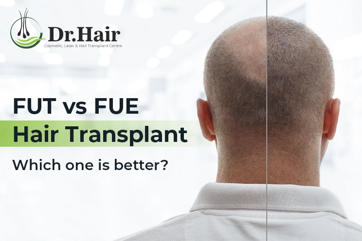 FUT V/S FUE Hair Transplant- Which One is Better ?